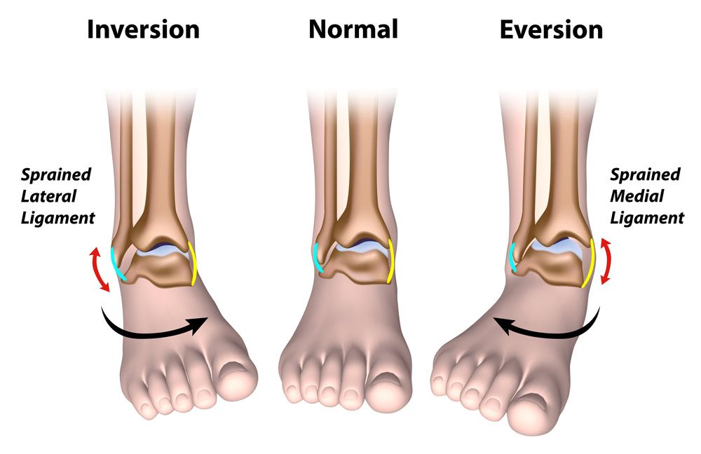 Illustration of ankle injuries.