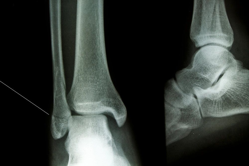 X-ray of an ankle fracture.